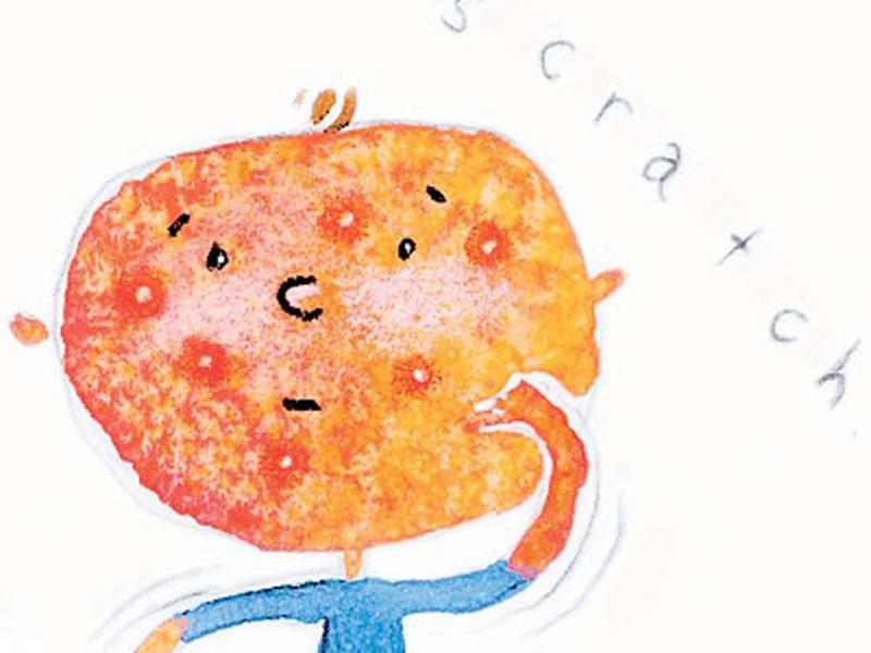 Chickenpox 2 ILLUS.jpg